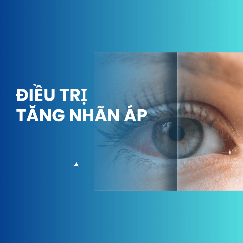 Điều trị tăng nhãn áp (Glaucoma)