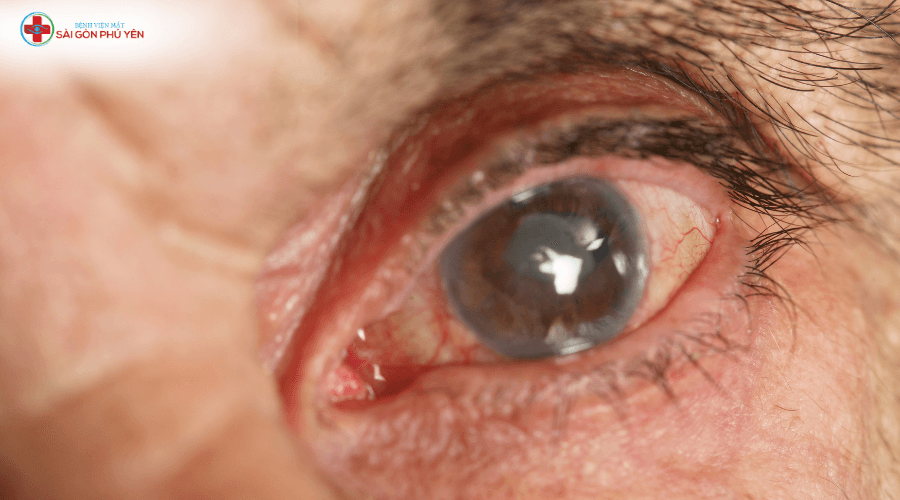 Phẫu thuật Phaco điều trị đục thủy tinh thể 1