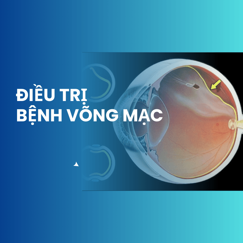 Điều trị bệnh võng mạc – Bảo vệ thị lực với công nghệ hàng đầu
