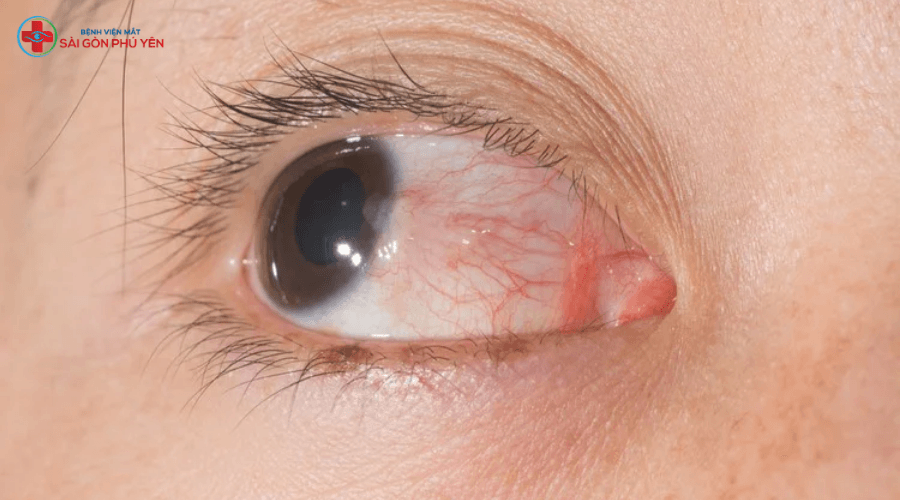 Phẫu thuật mộng thịt tại BV mắt Sài Gòn Phú Yên
