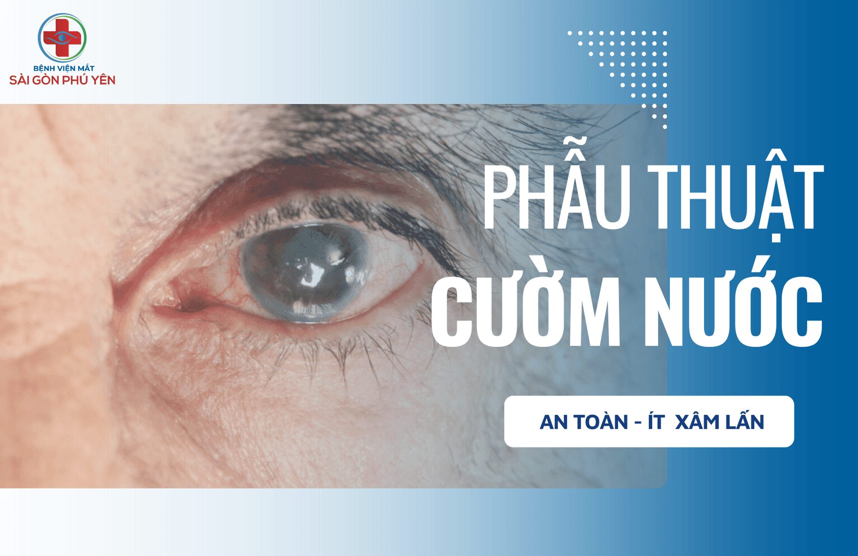 Phẫu thuật cườm nước