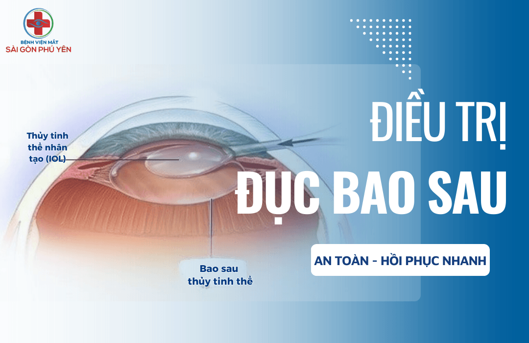Điều trị đục bao sau