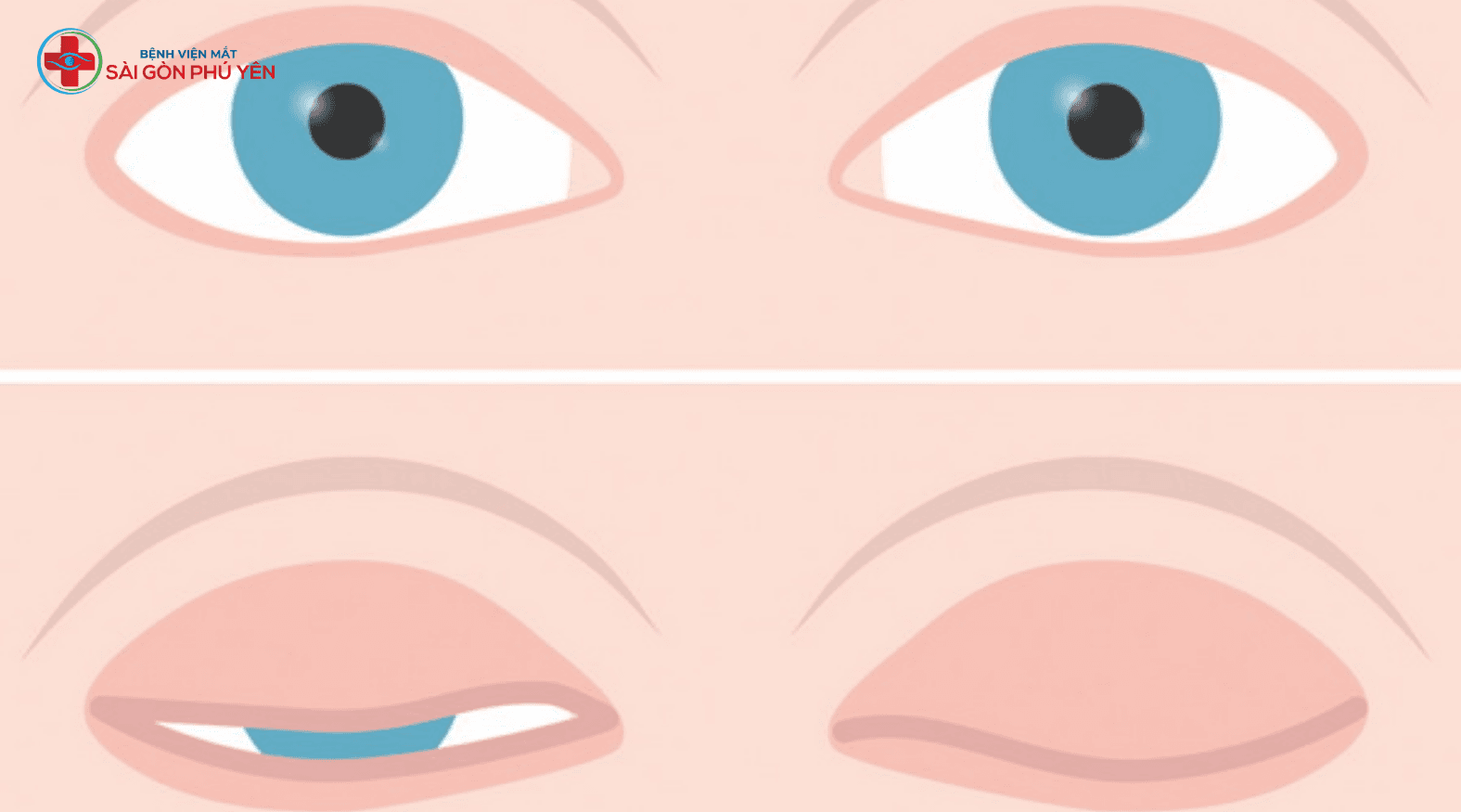 Phẫu thuật điều trị hở mi tại bệnh viện Mắt Sài Gòn Phú Yên