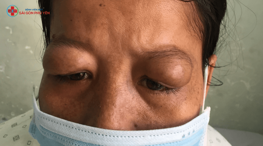 Phẫu thuật u mi ở Phú Yên