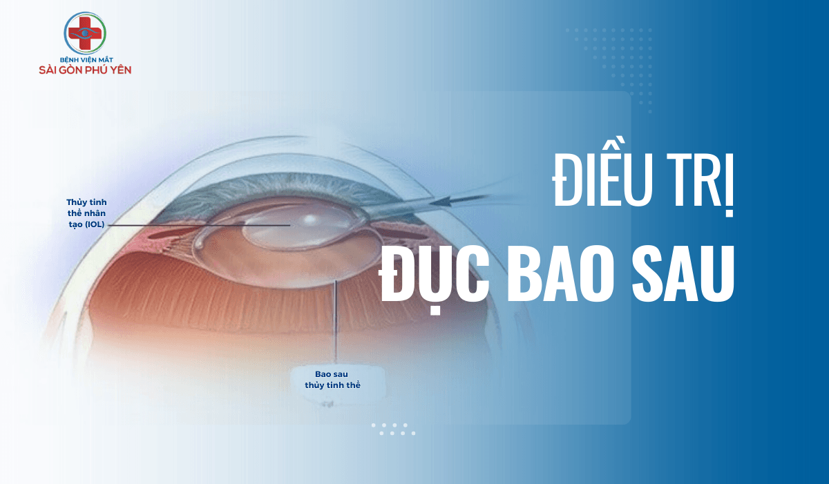 Điều trị Đục bao sau (PCO) sau phẫu thuật đục thủy tinh thể