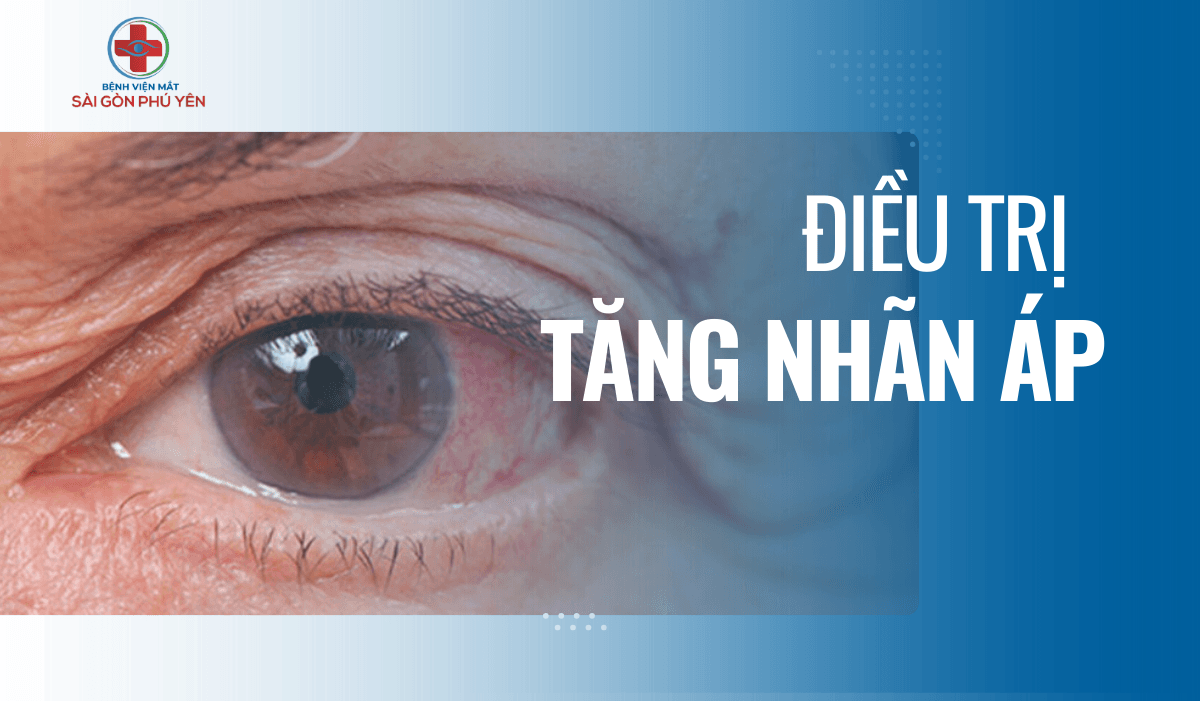 Điều trị tăng nhãn áp